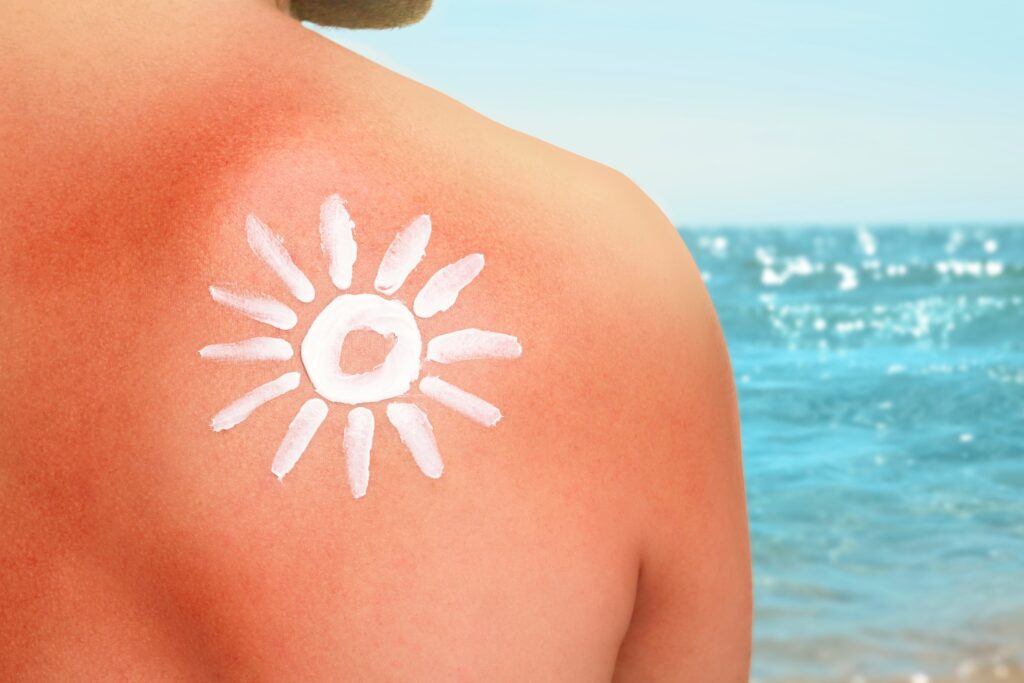Understanding Sunburn_ Causes, Treatment Options, and Effective Prevention Strategies